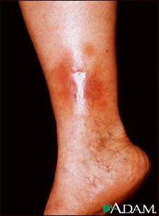 Dermatitis, stasis on the leg