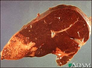 Hodgkin's disease, liver involvement