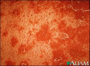 Pityriasis rubra pilaris - close-up