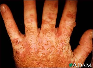 Porphyria cutanea tarda on the hands