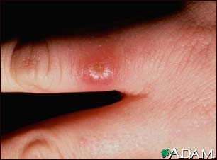 Leishmaniasis on the finger