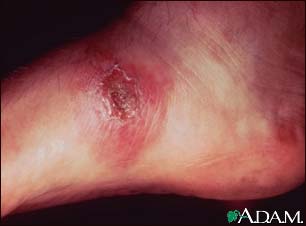 Leishmania panamensis on the foot