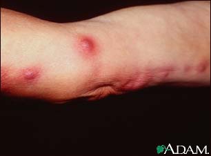 Sporotrichosis on the arm