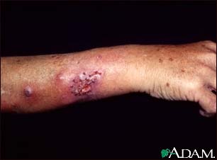 Sporotrichosis on the forearm