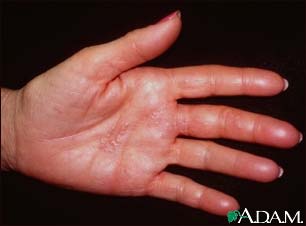 Herpes zoster (shingles) on the hand