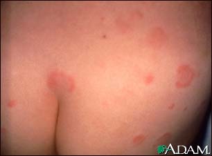 Hives (urticaria) on the back and buttocks