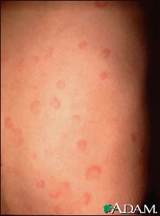 Hives (urticaria) on the back