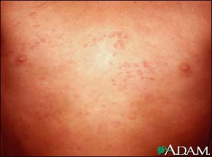 Hives (urticaria) on the chest