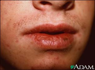 Cheilitis, actinic