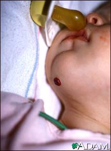 Hemangioma on the chin