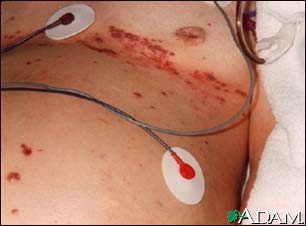 Herpes zoster (shingles), disseminated