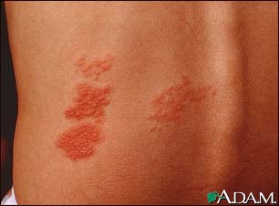 Herpes zoster (shingles) on the back