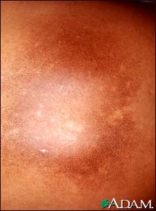 Post-inflammatory hyperpigmentation 2