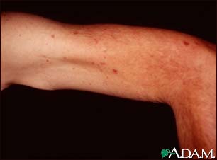 Telangiectasias - upper arm