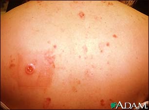 Multiple Basal cell cancer due to x-ray therapy for acne