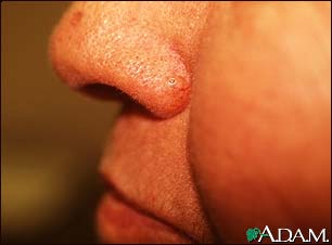 Basal cell carcinoma - nose