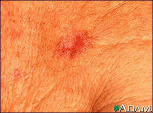 Basal Cell Carcinoma - close-up