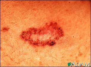 Basal Cell Carcinoma - close-up