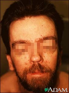 Basal cell nevus syndrome - face