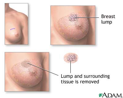 Excision of breast lump