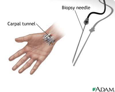 Carpal biopsy