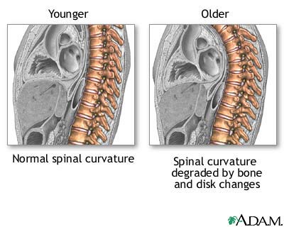 Changes in spine with age