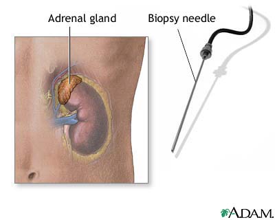 Adrenal gland biopsy