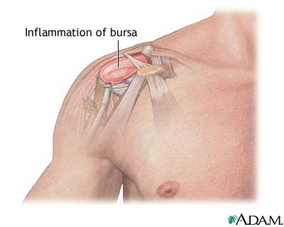 Bursitis of the shoulder