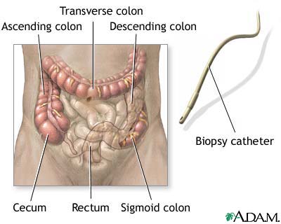 Colonoscopy