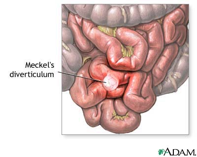 Meckels diverticulum