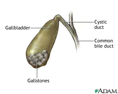 Gallstones