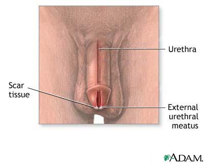 Meatal stenosis