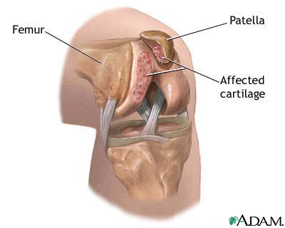 Chondromalacia of the patella