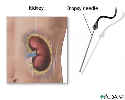 Renal biopsy