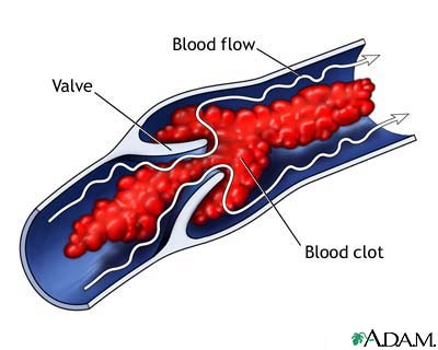 Venous blood clot