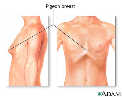 Bowed chest (pigeon breast)