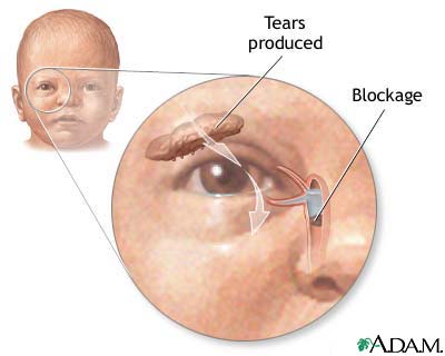 Tear duct blockage