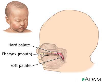 Infant hard and soft palates