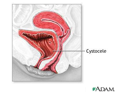 Cystocele