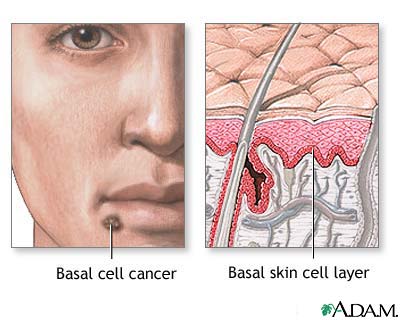 Basal cell cancer