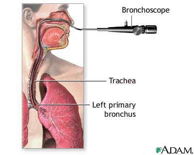 Bronchoscopy