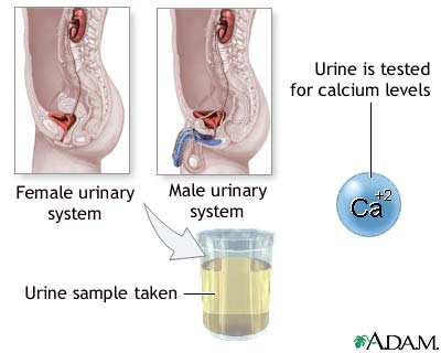 Calcium urine test