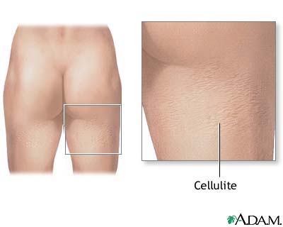 Cellulite