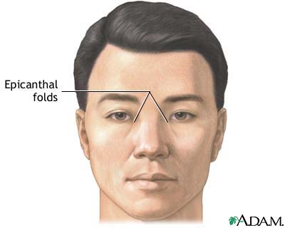 Epicanthal folds