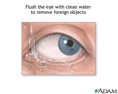 Foreign objects in eye