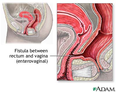 Fistula