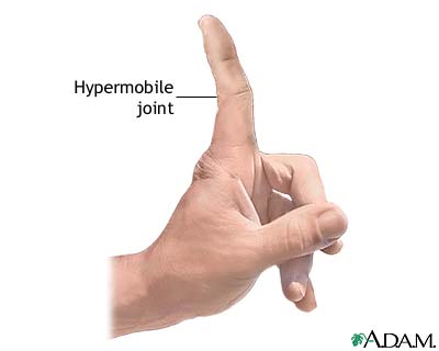 Hypermobile joints