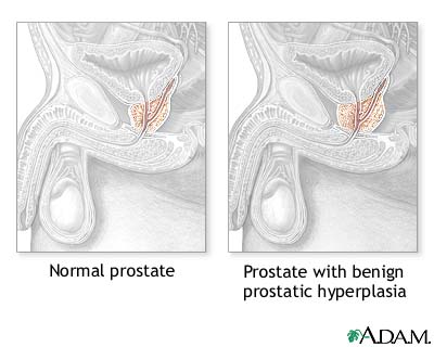 Hyperplasia