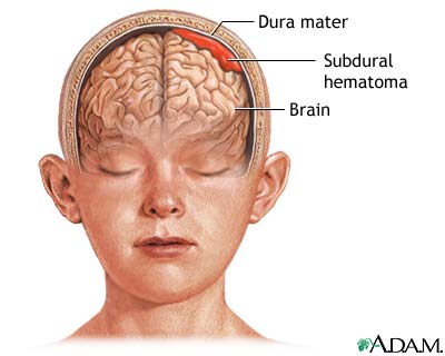 Subdural hematoma