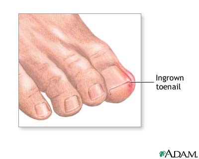 Ingrown toenail